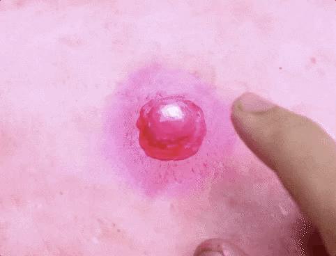 痘痘痘印痘坑改善全过程,学生祛痘痘和痘印痘坑简单的方法