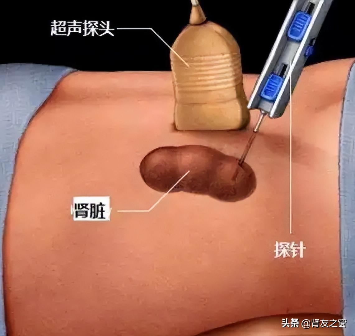 肾穿刺活检会加重病情吗,肾活检会不会导致肾功能受损