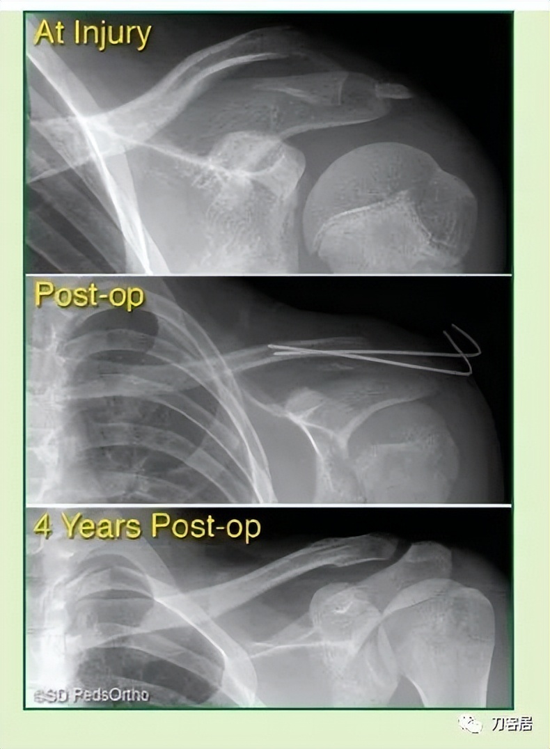 儿童锁骨骨折保守治疗的弊端,锁骨粉碎骨折错位不处理会愈合吗