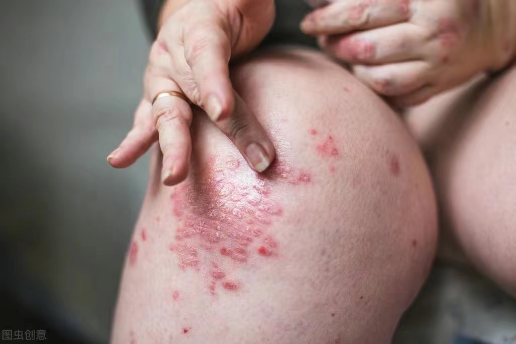 得顽固牛皮癣能彻底治吗,有牛皮癣刮皮会怎么样