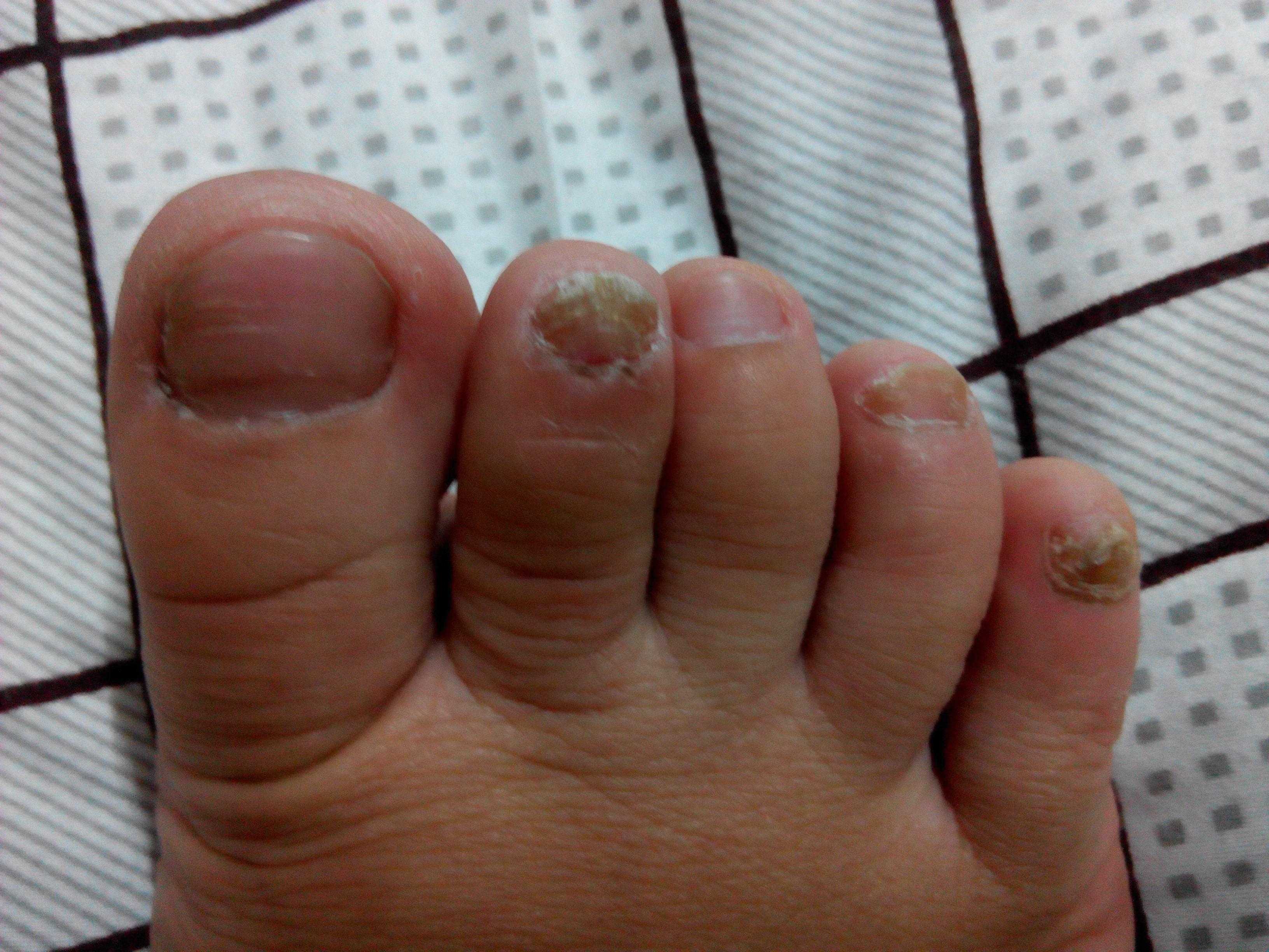 灰指甲到底怎么才能彻底治好,灰指甲怎么治最好的偏方大全