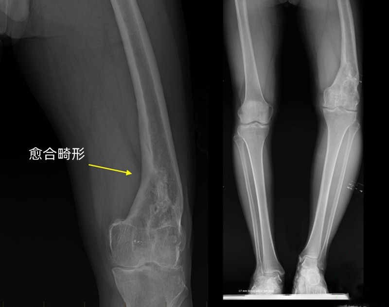 骨折后两条腿不一样长,骨折后腿不一样长应该怎么办