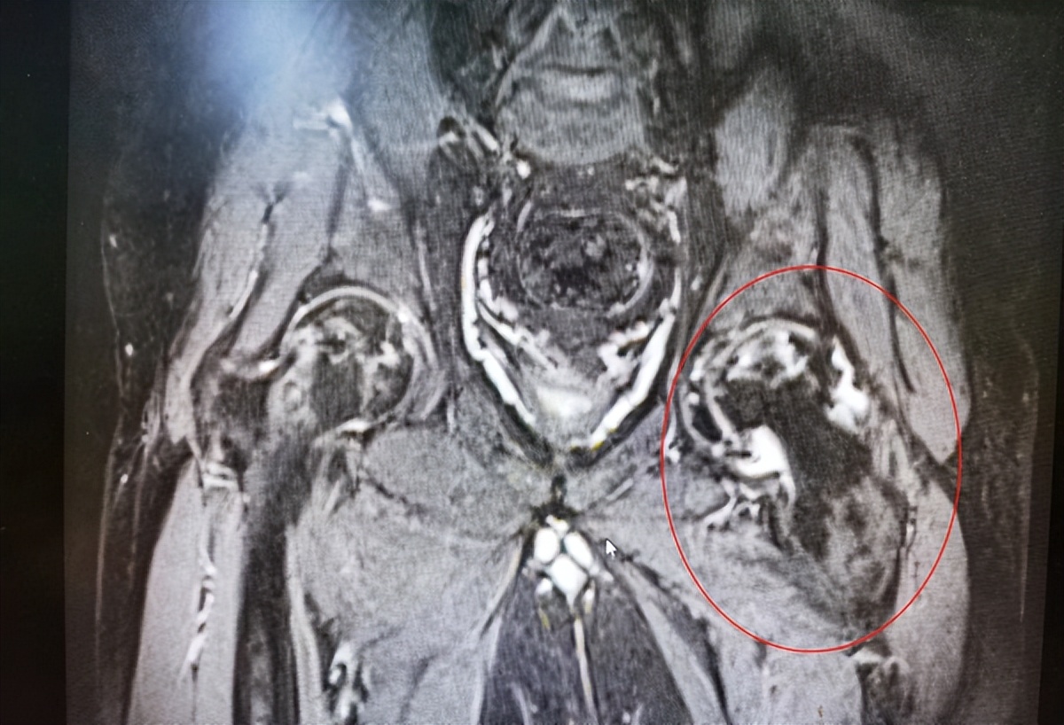 网购“特效药”治痛风，32岁小伙儿出现急性肾衰竭