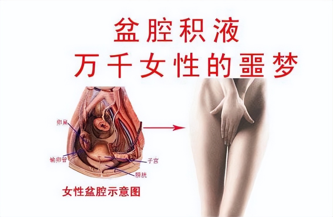 体检发现盆腔积液是盆腔炎吗?