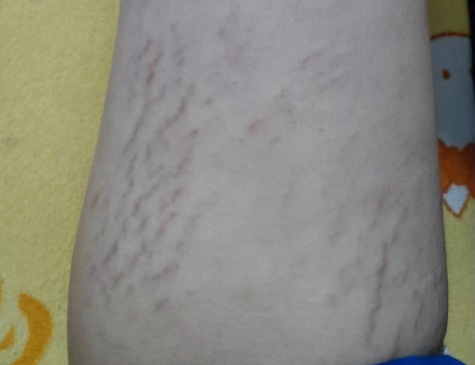 肥胖纹目前最好的去除办法,淡化肥胖纹修复肥胖纹