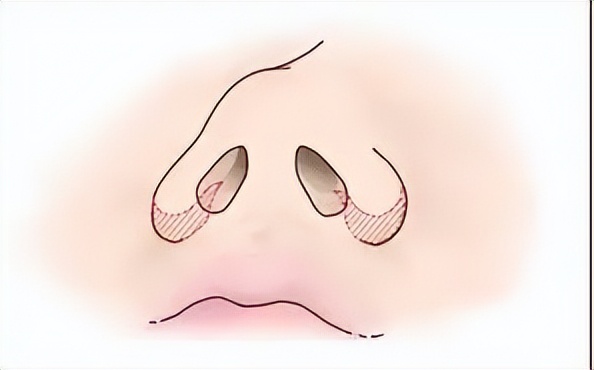 上海九院韦敏做的鼻子,上海九院韦敏和张盈帆隆鼻哪个好