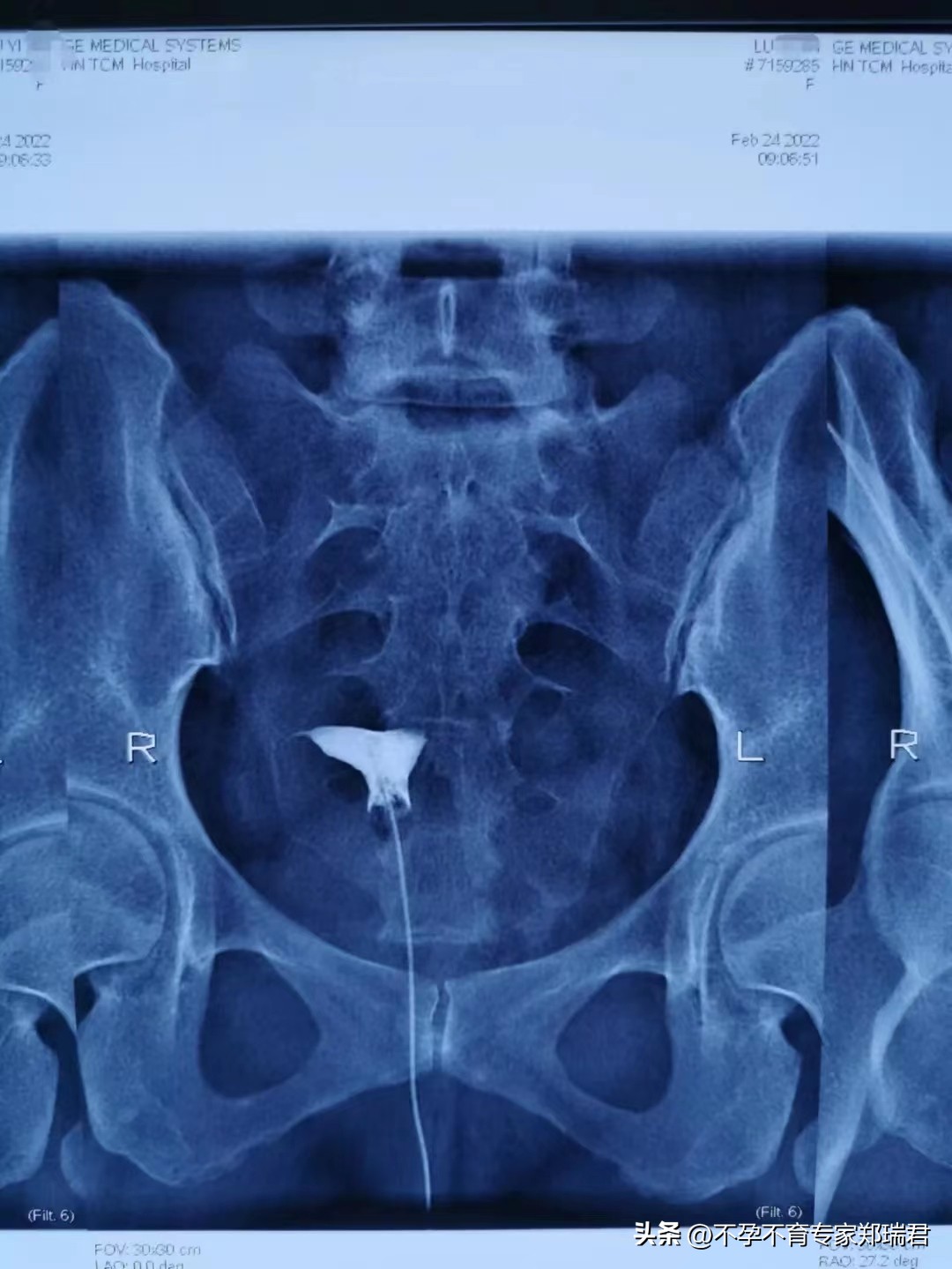 一侧输卵管不通能怀孕吗,输卵管一边通一边不通能怀孕吗