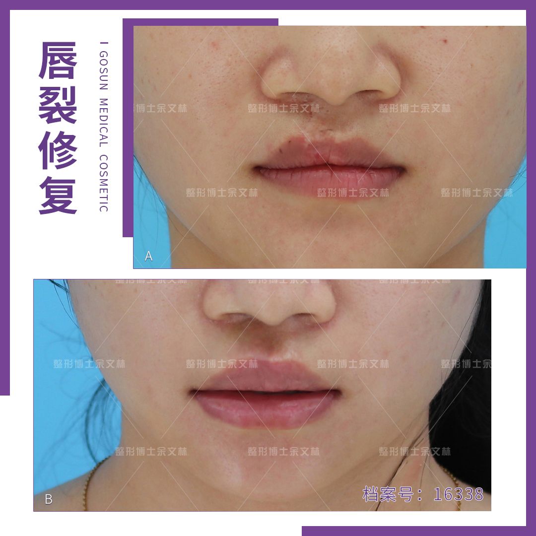唇裂术后显示红唇缺失,唇裂手术后红唇一侧偏厚正常吗