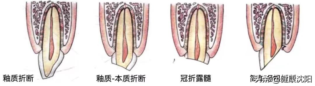 孩子换牙旧牙齿该怎么处理,小孩牙齿受伤换牙受影响吗