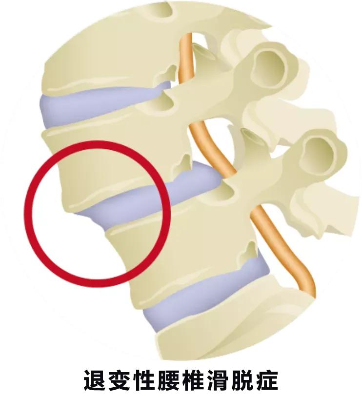 腰椎4节滑脱怎样治疗,中医怎样治疗腰椎滑脱