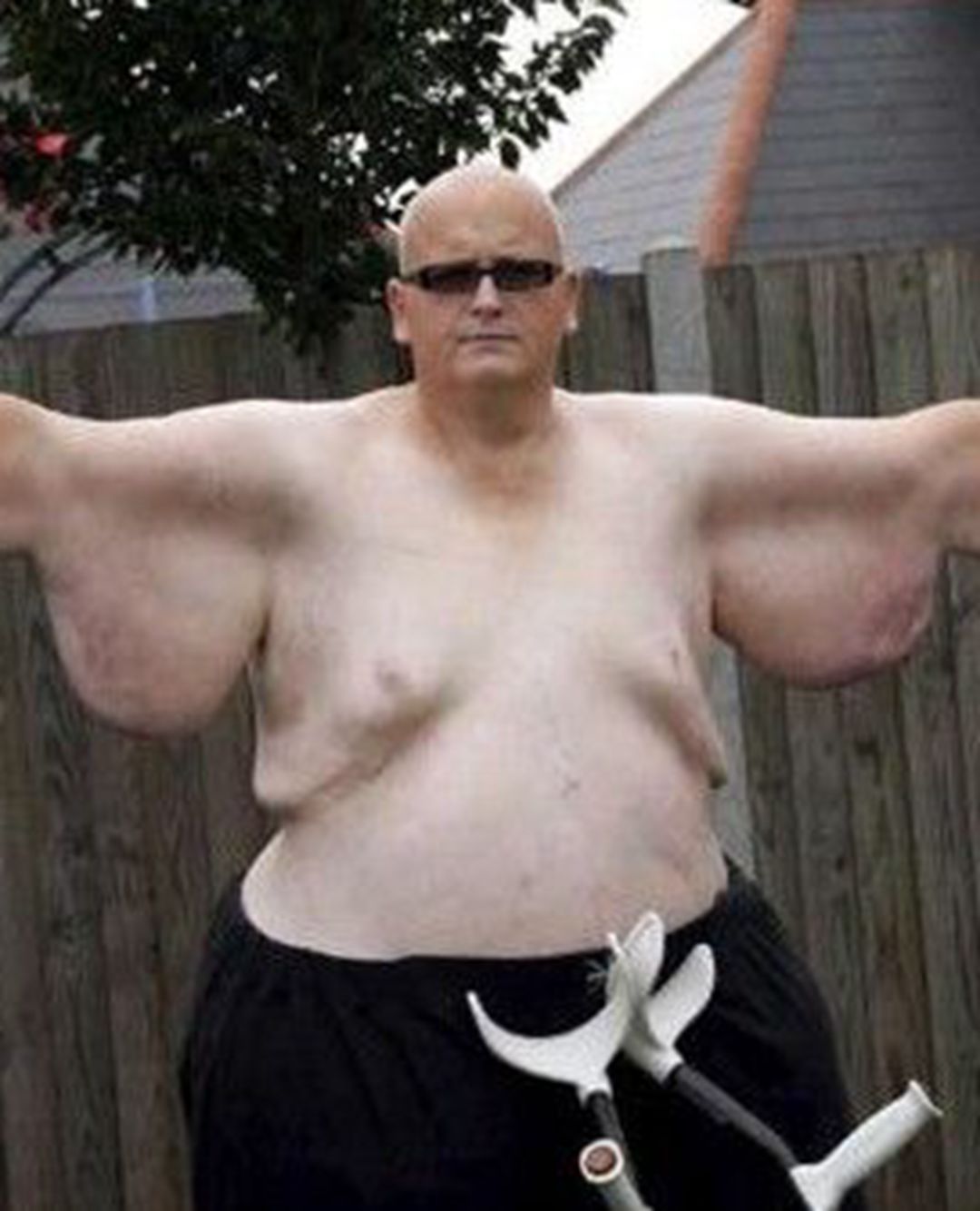 减肥快皮肤松弛需要多久能恢复,减肥皮肤松弛的原因和改善方法