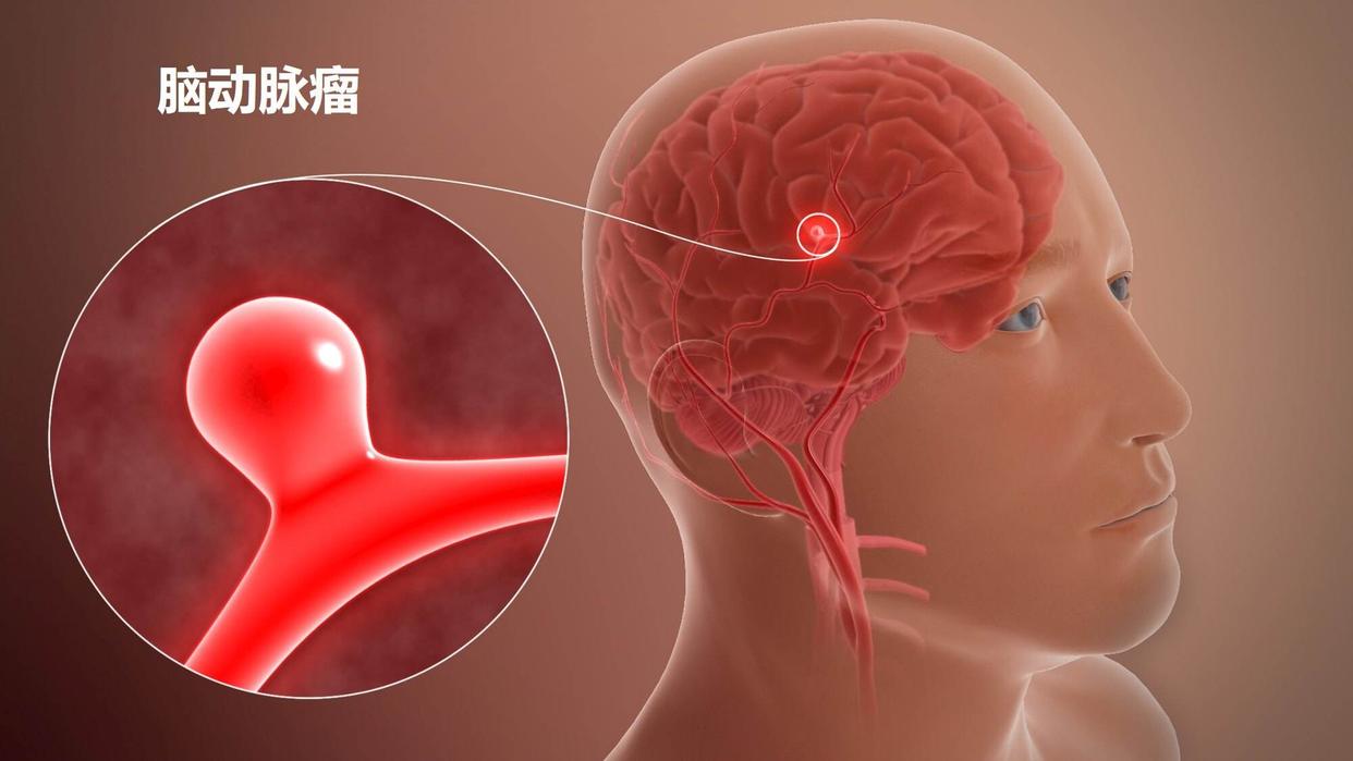 脑出血来临睡觉先知,脑出血睡觉出现三个异常