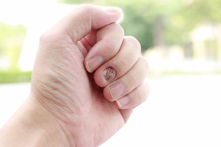 身上有癌指甲有什么变化,体内有癌皮肤先知6个信号别忽视