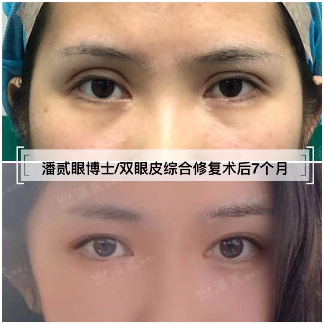 千万别被网红宽双眼皮*脑洗**了，对眉骨高眼窝深邃的人可能是灾难