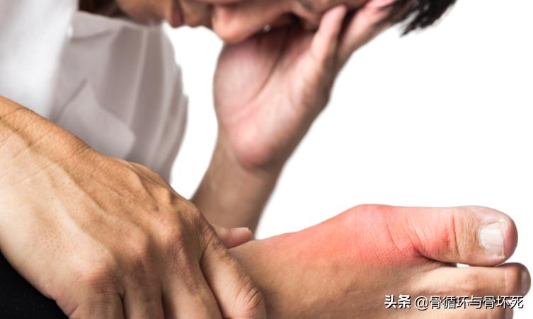 非布司他是不是最好的痛风药,非布司他痛风病人吃得好吗