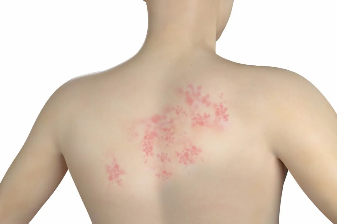 张仲景治疗湿疹反复发作的方子,宝宝湿疹反复发作的原因是什么