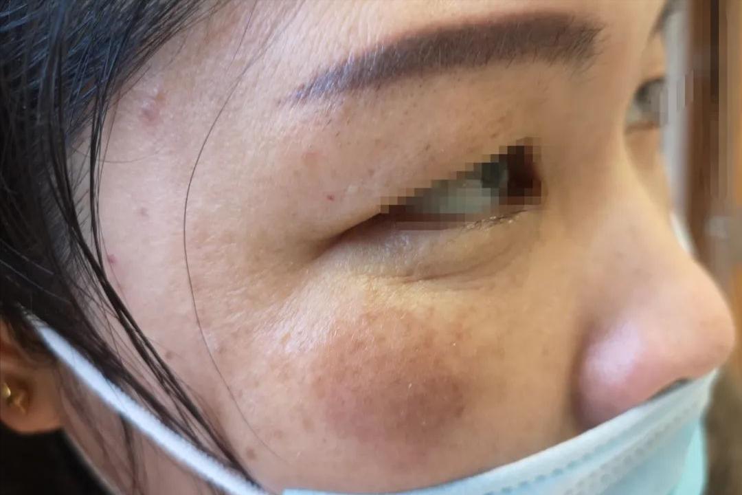 炎症后皮肤粗糙增厚发黑,炎症后脸上留下黑斑