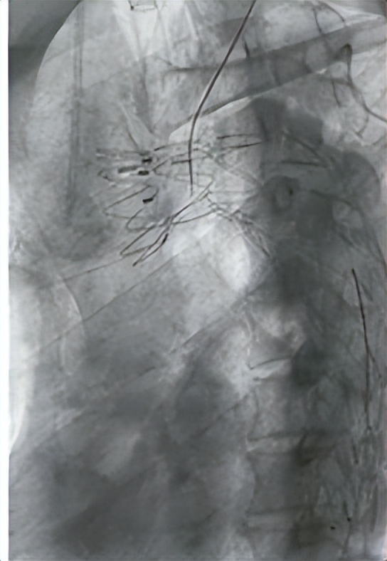 胸主动脉夹层真实经验,胸主动脉夹层的介入治疗方法