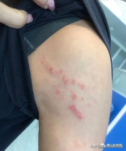 九月初预警：隐翅虫年度盛典，奇怪皮炎频现，教您如何躲着点