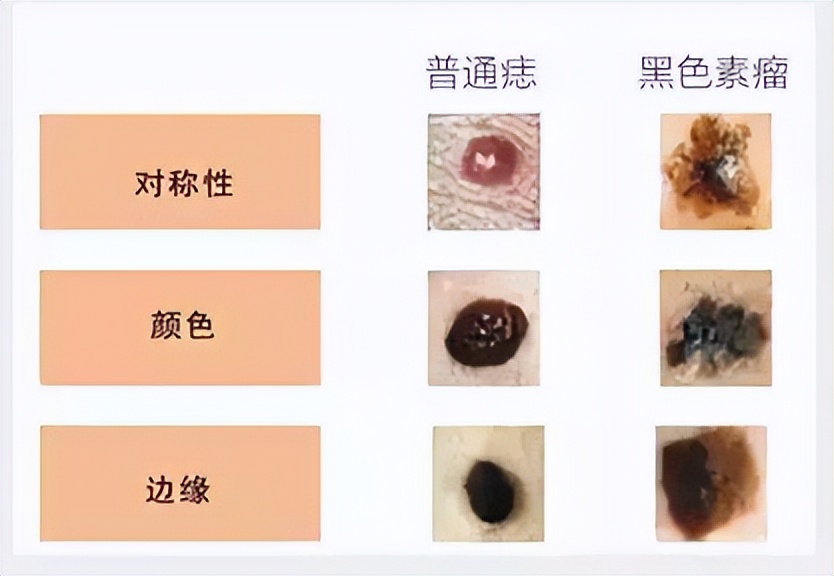 长在身体什么部位的痣容易癌变,脖子突然长痣是癌症的症状