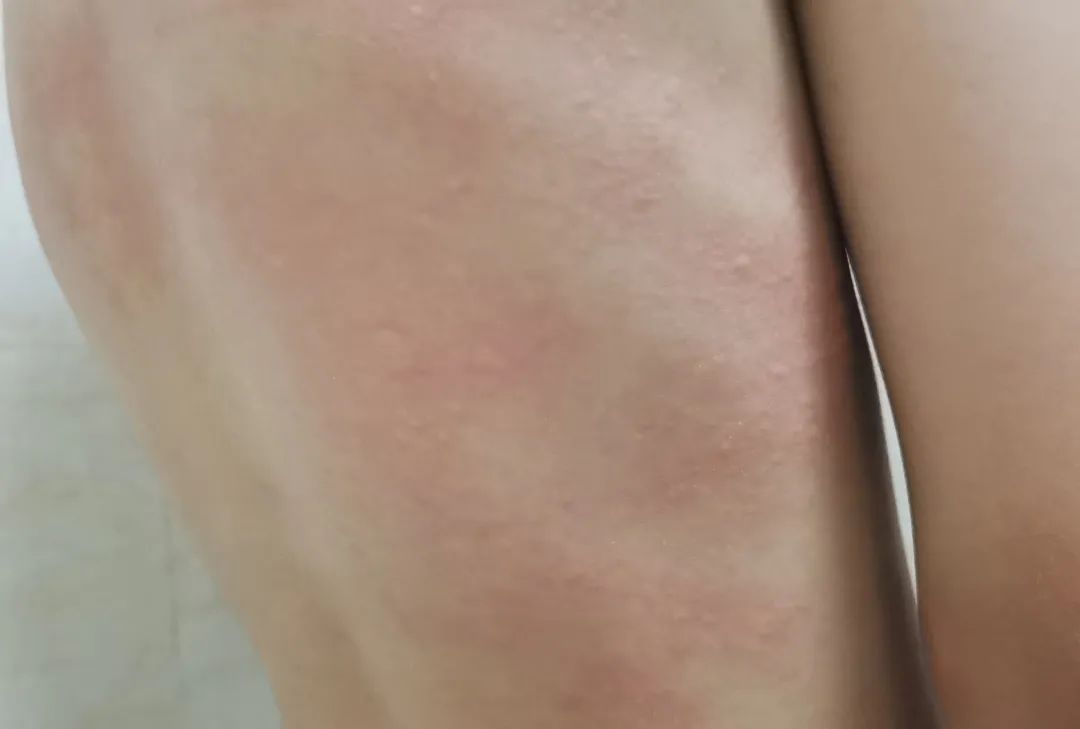 夏天孩子皮肤痒抓破皮,小孩子皮肤干燥发痒都抓出血来