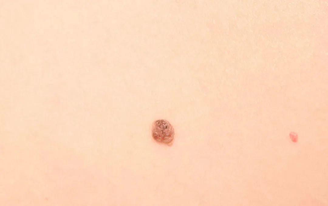 如何判断新长的痣是不是黑色素瘤,正常痣和黑色素痣图片对比说明