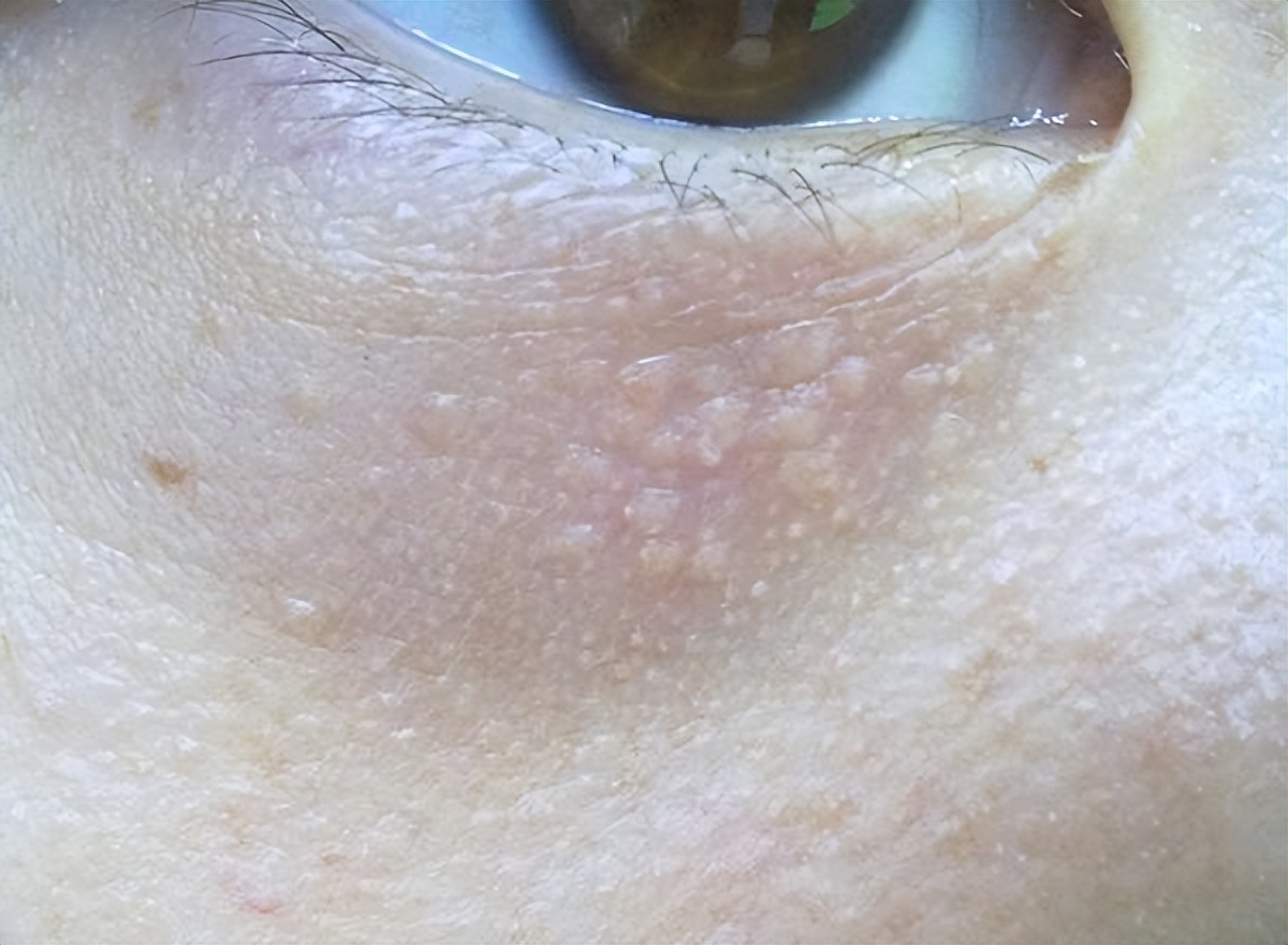 葛林若脸部为什么会长脂肪粒？怎么样护理去除？