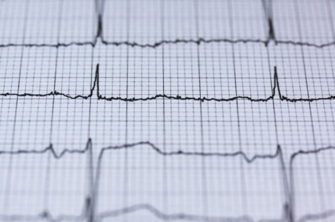 自测心率最高141最低41正常吗,心率低于60到医院应检查什么