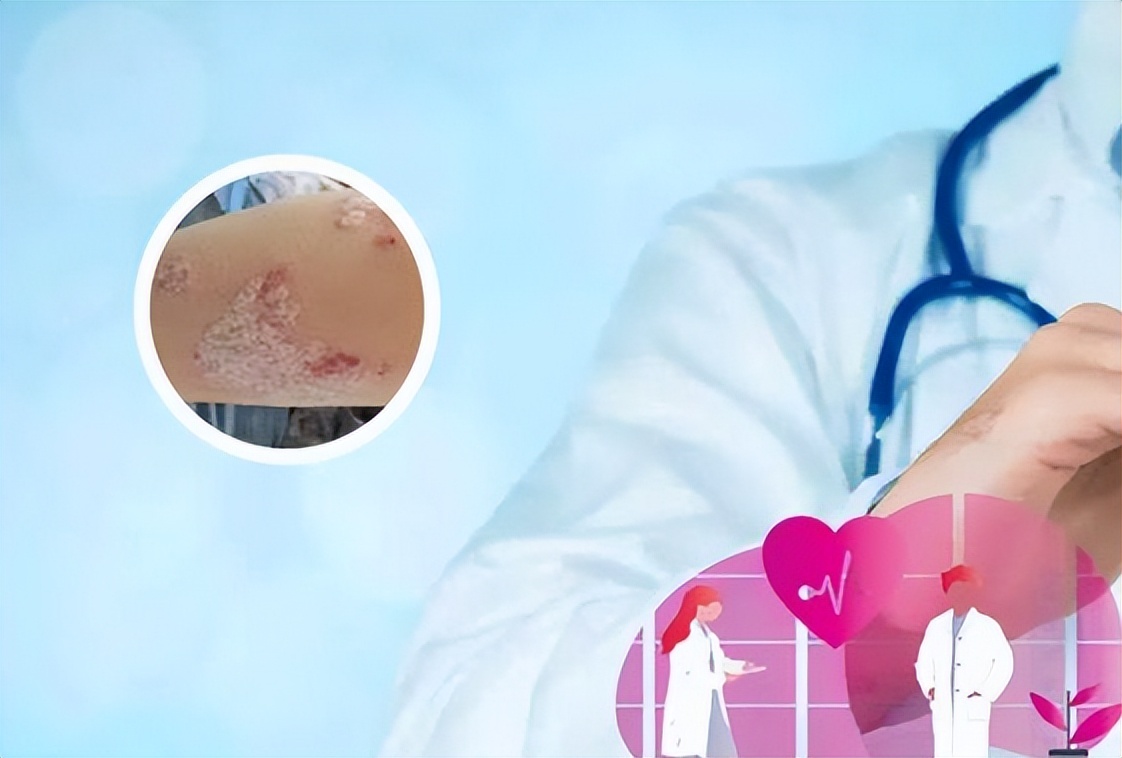 患上银屑病的四大罪魁祸首,银屑病人应该注意什么