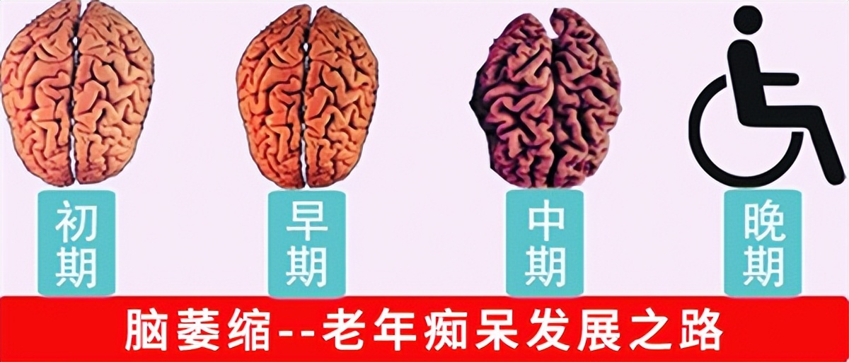 年龄大了得了脑萎缩该如何解决,50多岁轻微脑萎缩要注意什么