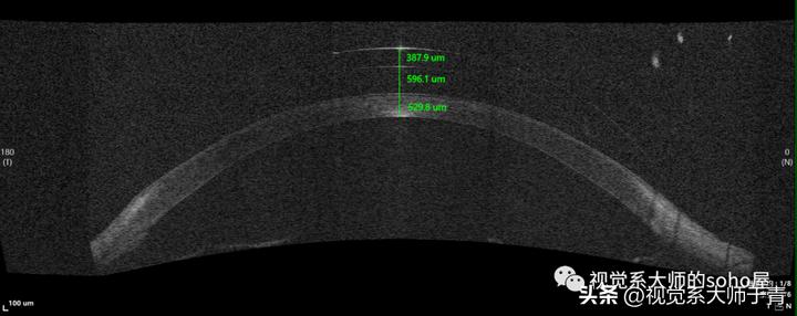 巩膜镜的验配技巧及案例分享,试戴巩膜镜成功率高不高