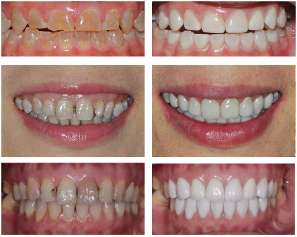 烤瓷牙的缺点危害亲身经历,烤瓷牙各有哪些优缺点