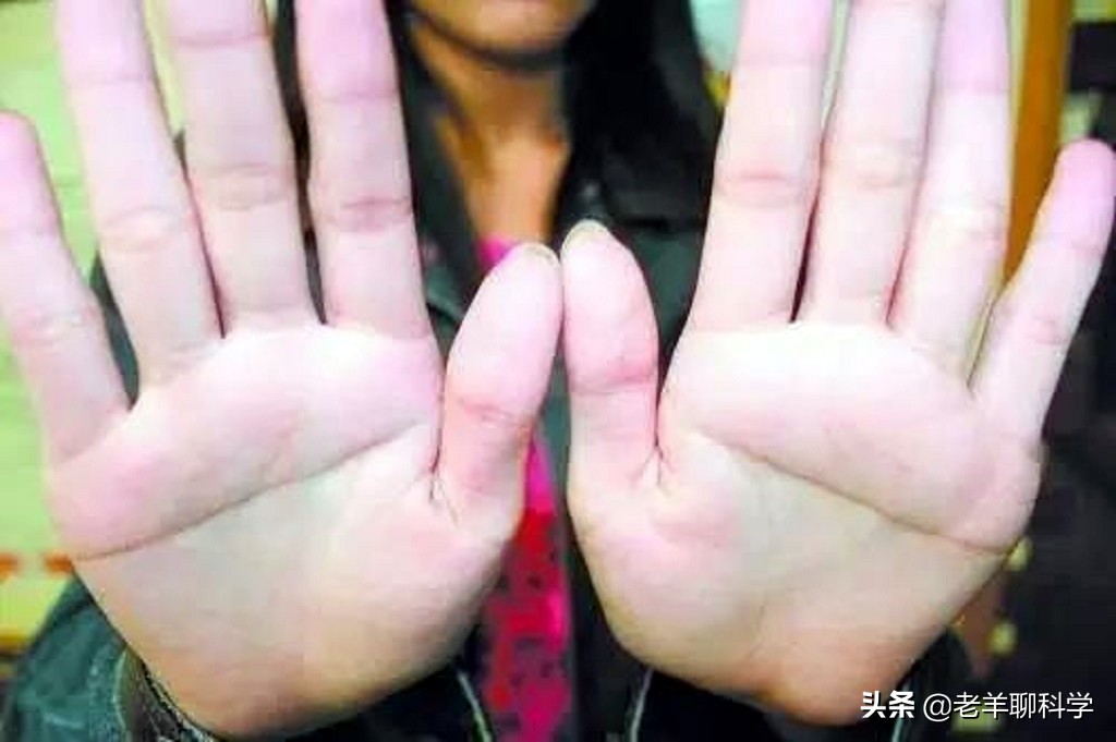 关于断掌纹的民间说法,断掌纹的性格有科学依据吗