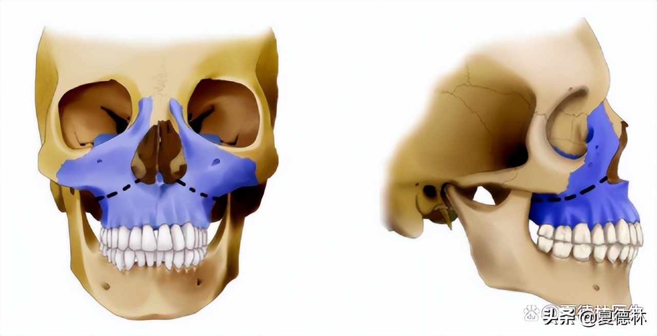 笑露牙龈怎么通过日常改善,为什么有些人笑起来露牙龈