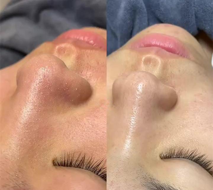 鼻子毛孔小黑头出不来怎么办,小女孩鼻子有黑头毛孔粗怎么办