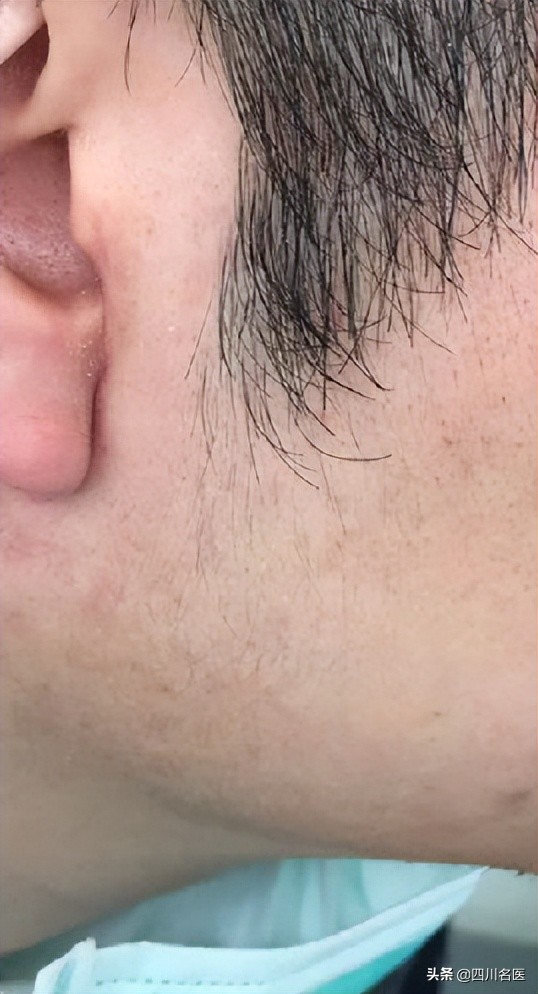 摸到颌面部肿瘤,摸到颌下有小疙瘩