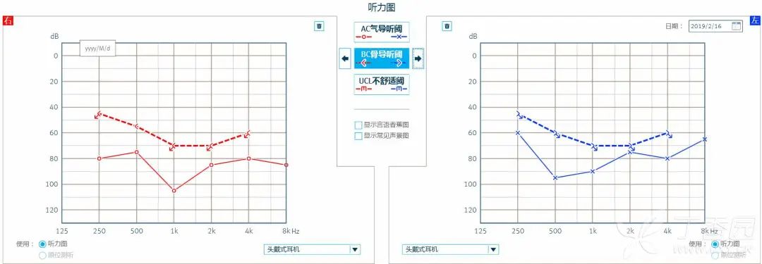 双耳听力相差需要助听器,双耳听力70分贝戴助听器有效吗