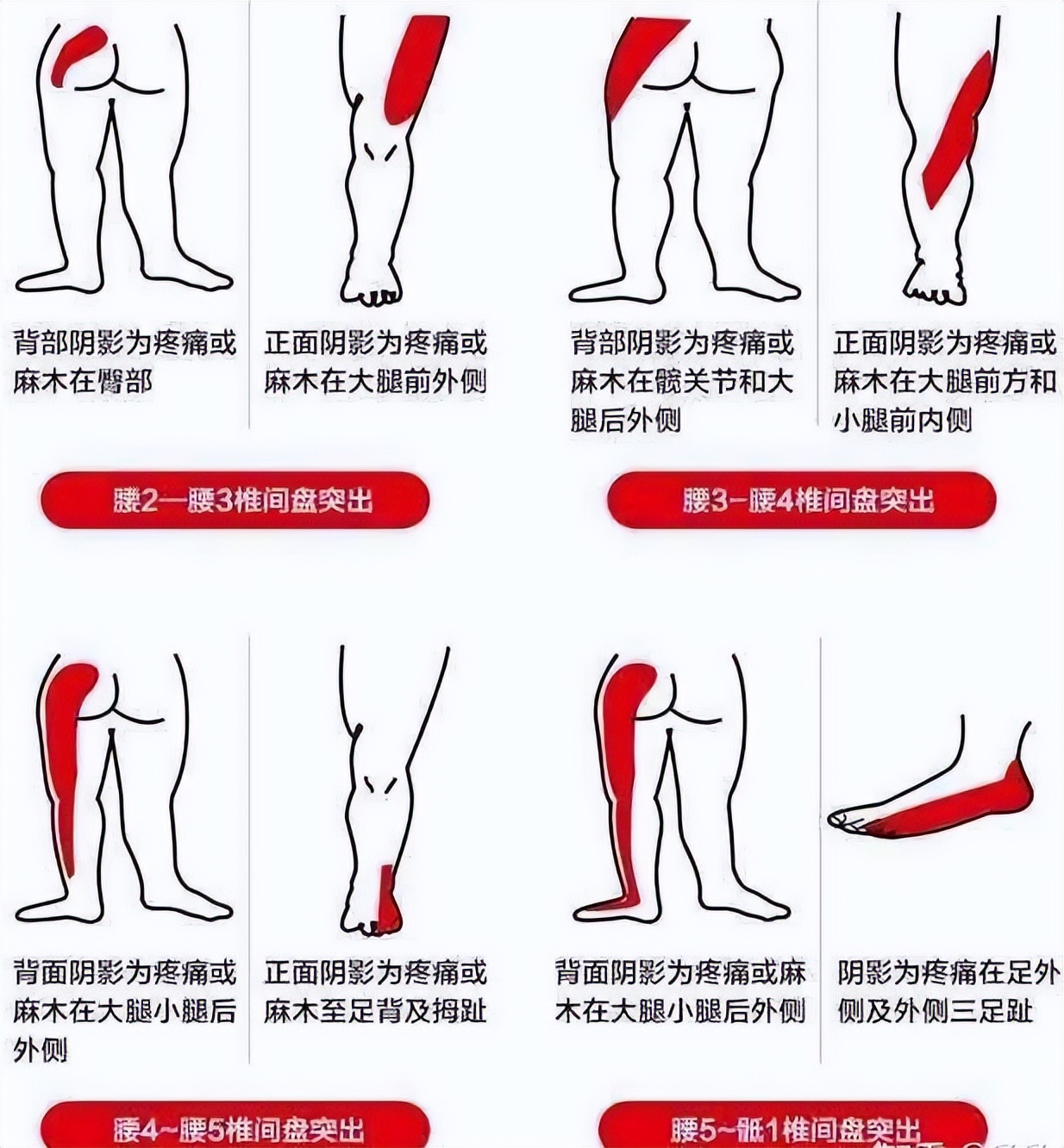 对于腰椎间盘突出症你真的了解吗,腰椎间盘突出的十个问题