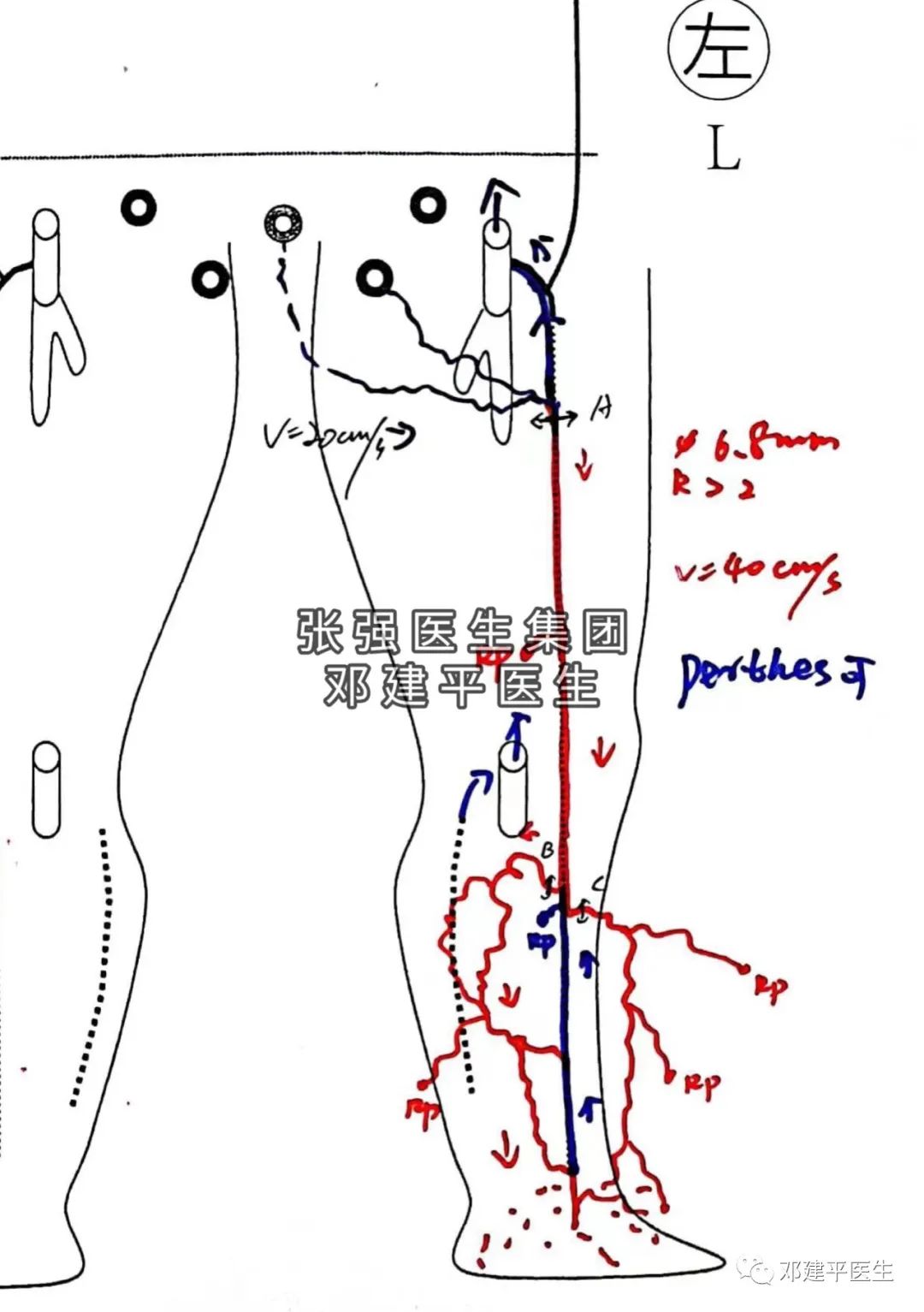下肢静脉曲张非手术治疗护理,下肢静脉曲张2级吃药可以消除吗