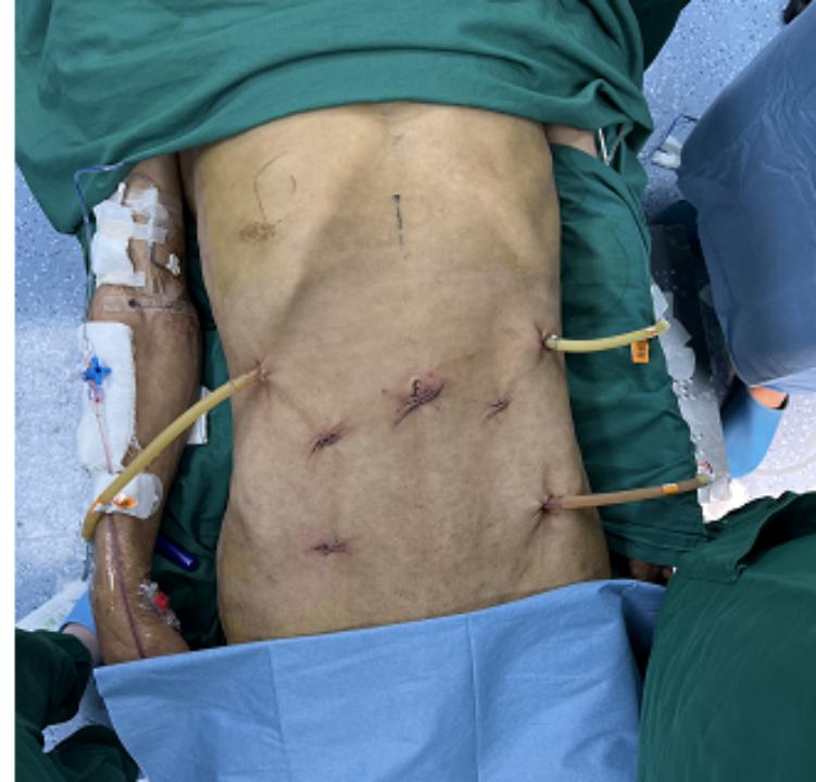 微创之声|烟台山医院胃肠外科“双镜合璧”完成一例无切口胃癌+直肠癌NOSES根治术