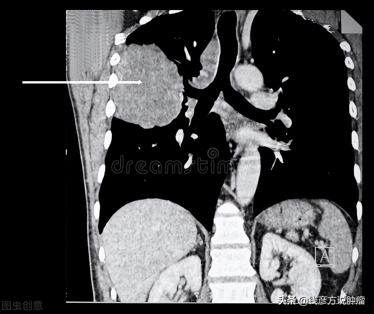 70岁肺癌晚期保守治疗还是化疗,75岁老人肺癌早期有必要化疗吗
