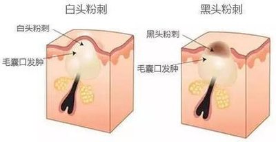 额头反复长小颗粒,额头密密麻麻的小颗粒怎么办