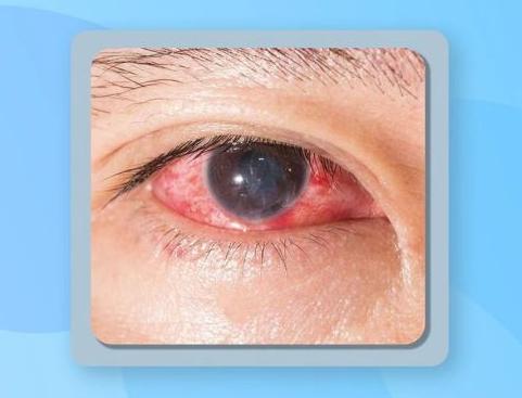 通过查眼睛能判断糖尿病吗,糖尿病眼科疾病的症状