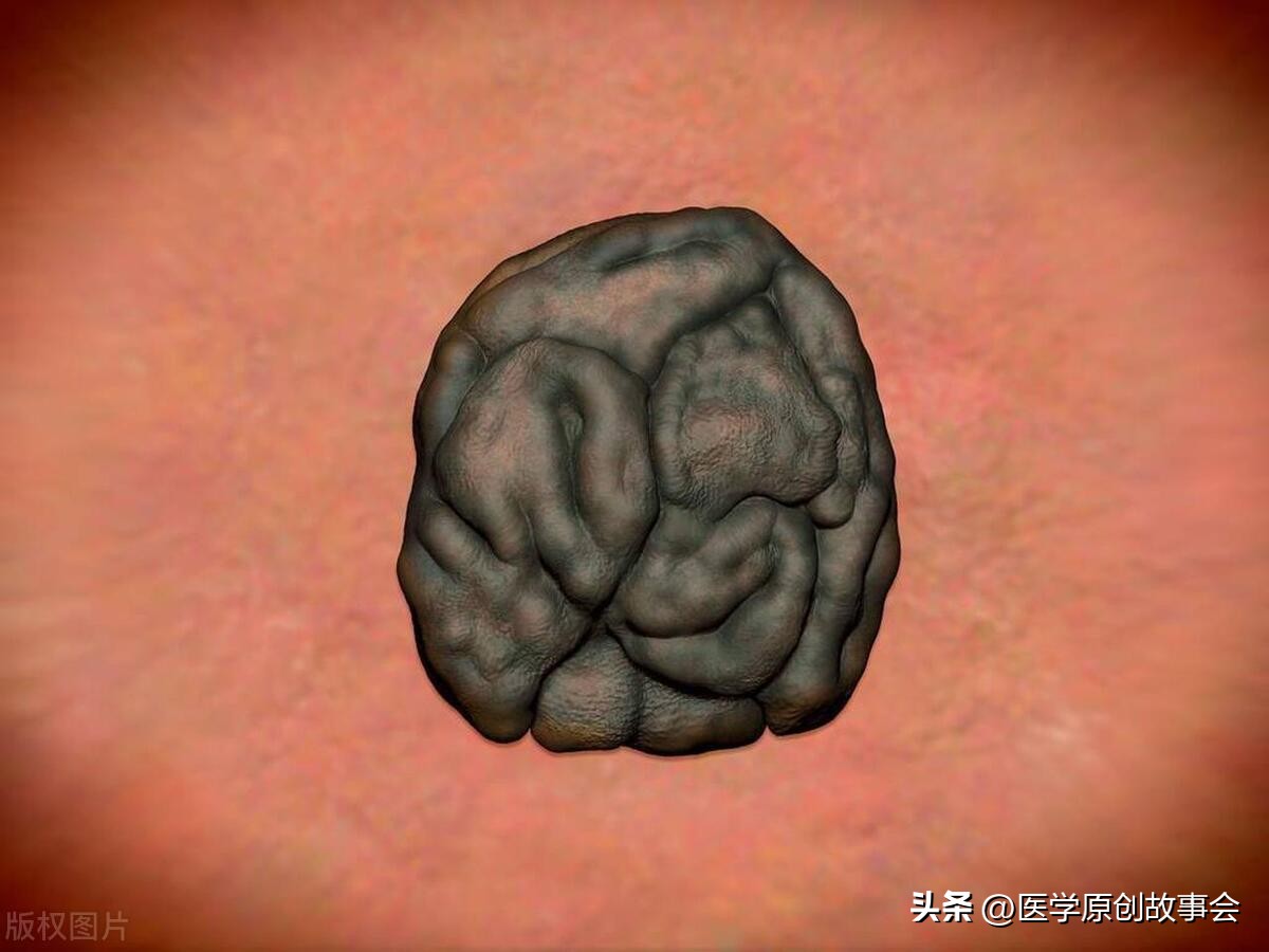 一旦皮肤上长了这5种痣,十有八九是黑色素瘤,一拖再拖会很麻烦