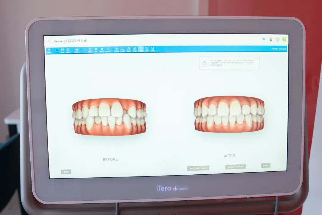 整牙亲身经历分享一下,整牙的经历分享