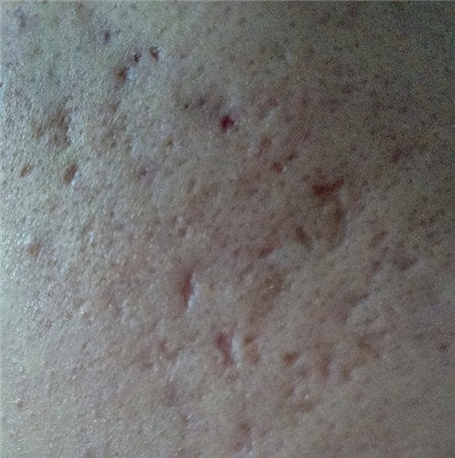 长青春痘了该如何把青春痘消掉,长青春痘的原因及解决方法