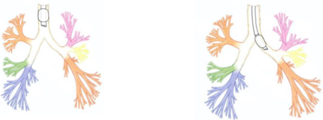 咯血一定要做支气管镜吗,支气管镜的注意事项