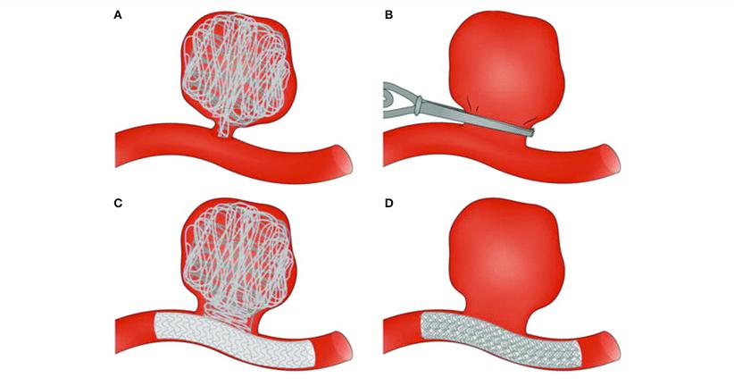 检查脑子里有瘤,检查出动脉瘤需要怎么处理
