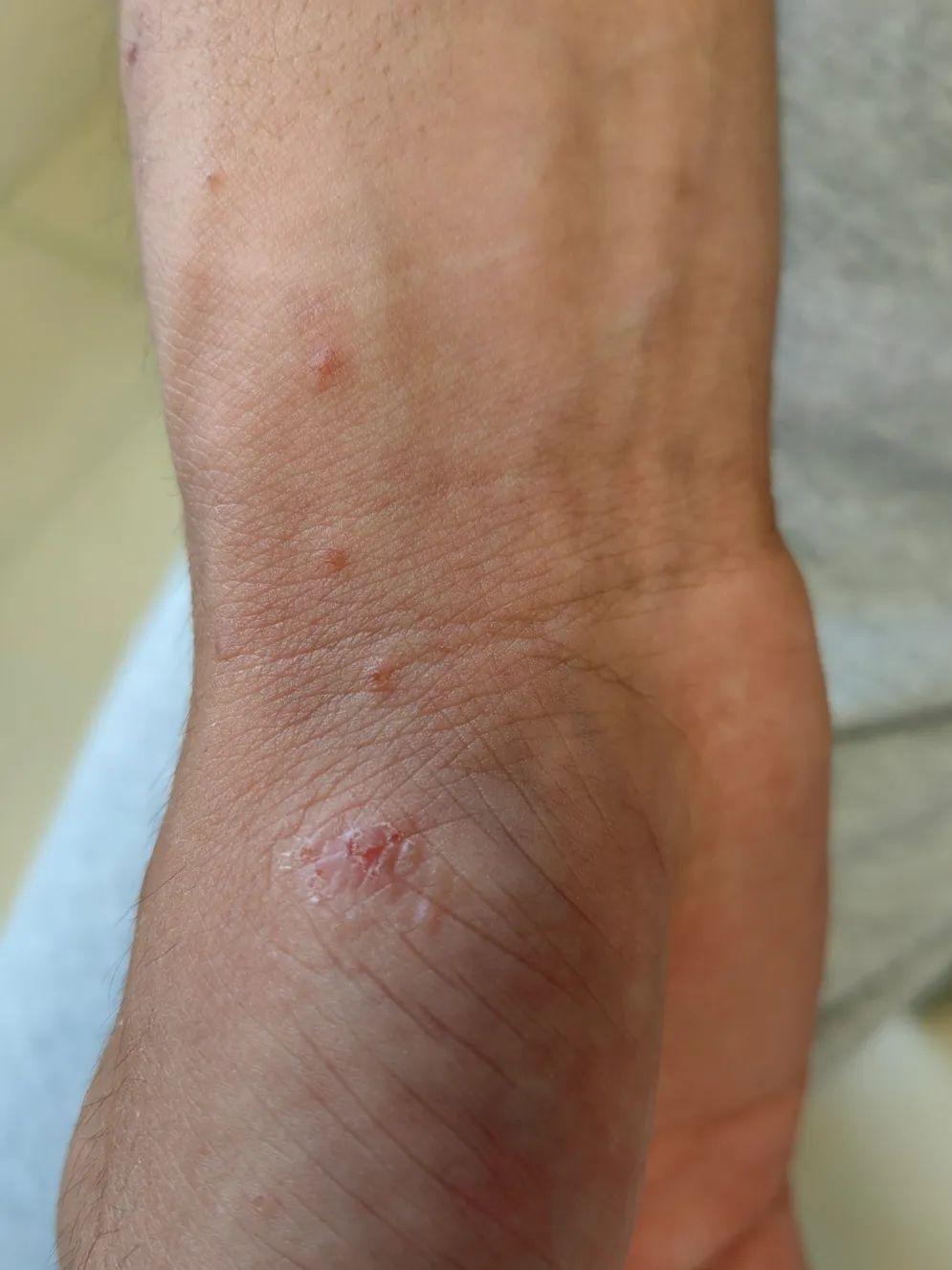 脖子前边痒是生病的前兆,腋窝和脖子痒是什么病的前兆