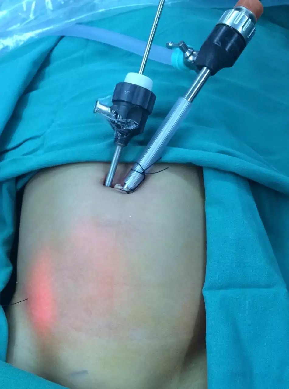 腹腔镜肾切除示意图,腹腔镜肾脏部分切除术